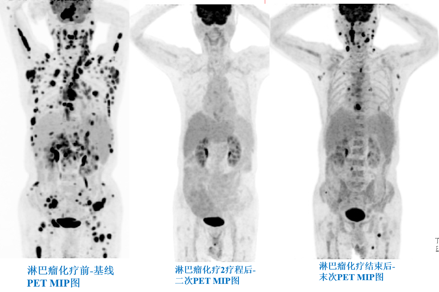 淋巴瘤化療前、中、后PETCT療效評(píng)價(jià).png