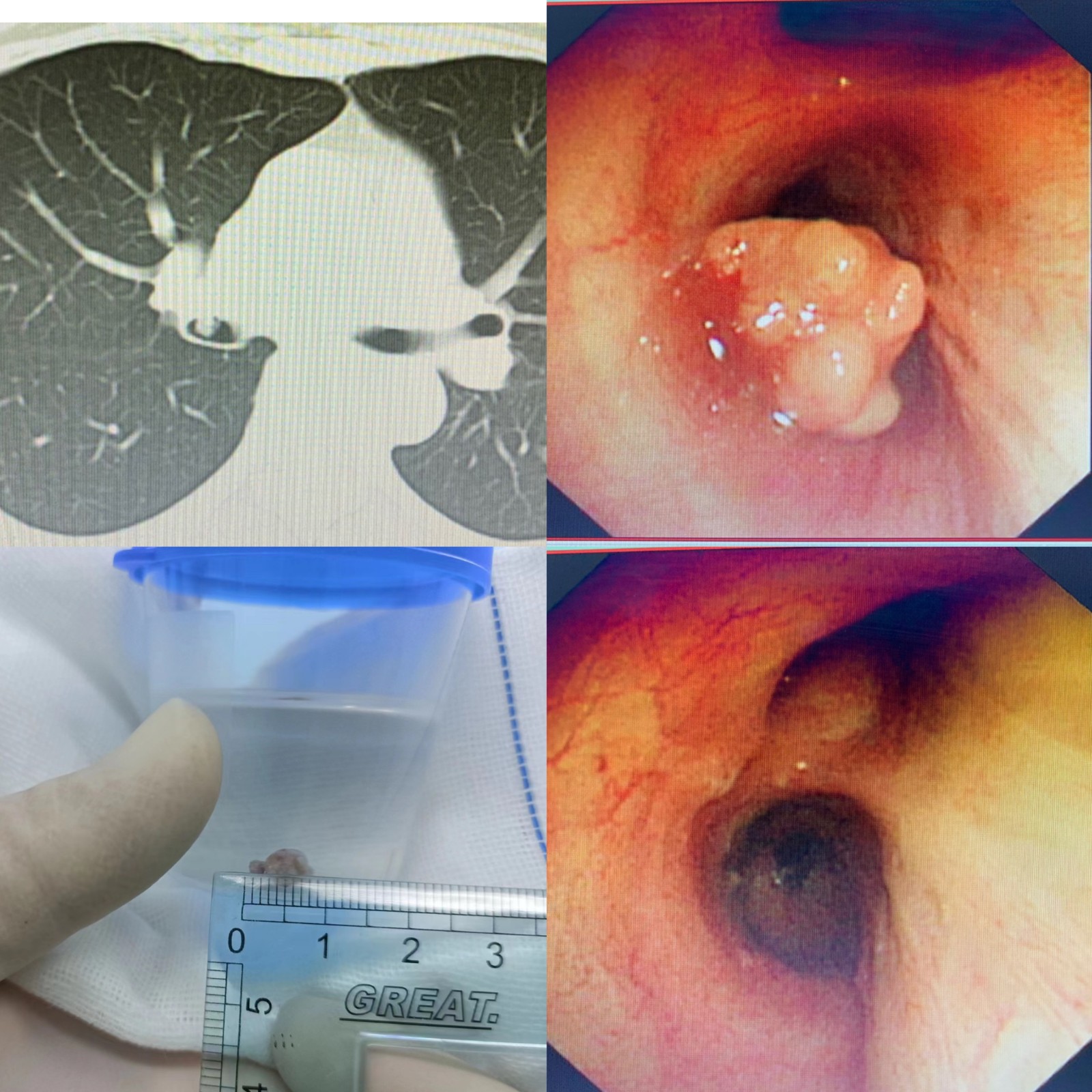 氣管內(nèi)腫物切除.jpg